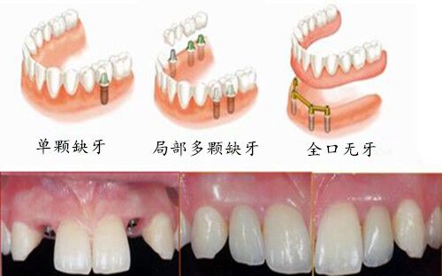 最新鑲牙技術(shù)重塑牙齒美觀與功能雙全